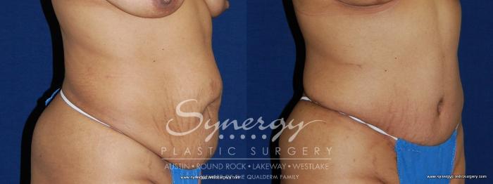 Before & After Abdominoplasty (Tummy Tuck) Case 156 View #3 View in Austin, TX