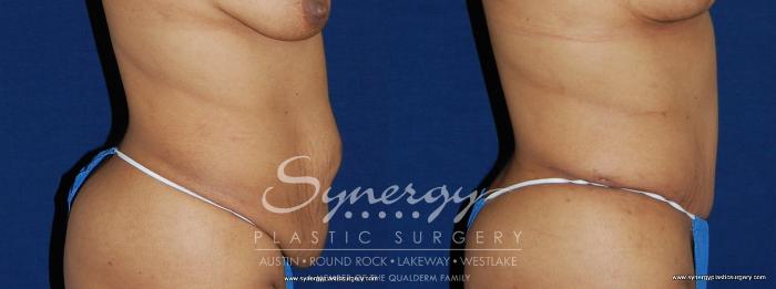 Before & After Abdominoplasty (Tummy Tuck) Case 156 View #4 View in Austin, TX