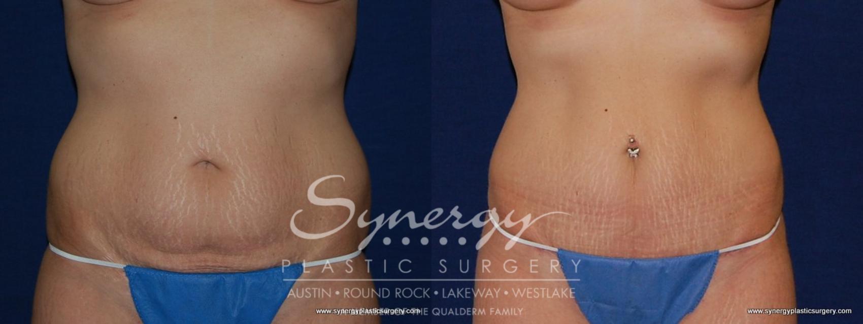 Before & After Abdominoplasty (Tummy Tuck) Case 179 View #1 View in Austin, TX
