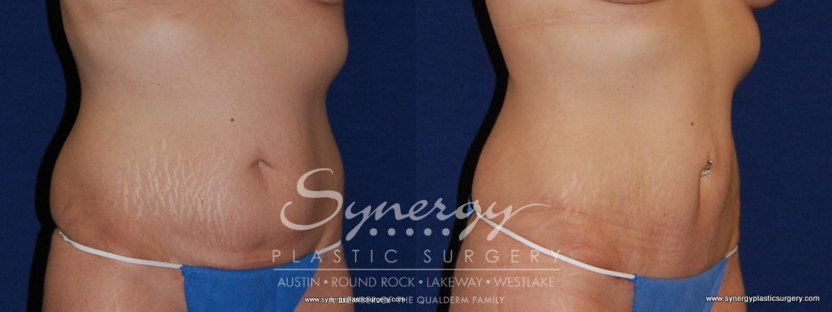 Before & After Abdominoplasty (Tummy Tuck) Case 179 View #2 View in Austin, TX