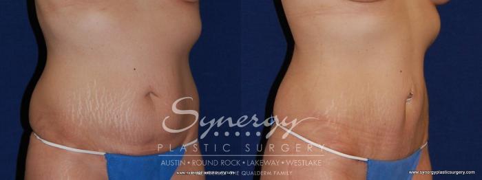 Before & After Abdominoplasty (Tummy Tuck) Case 179 View #2 View in Austin, TX