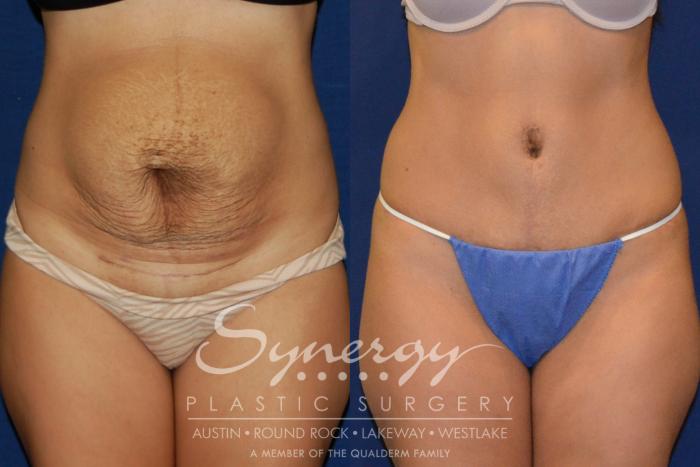 Before & After  Case 205 View #3 View in Austin, TX