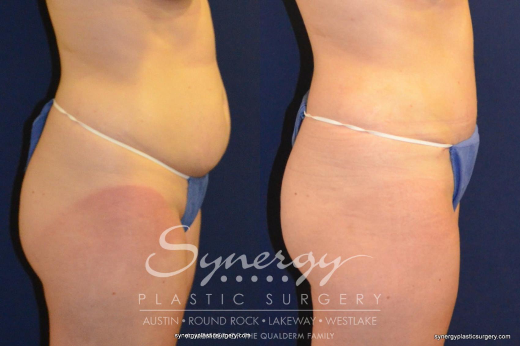 Before & After Abdominoplasty (Tummy Tuck) Case 216 View #1 View in Austin, TX