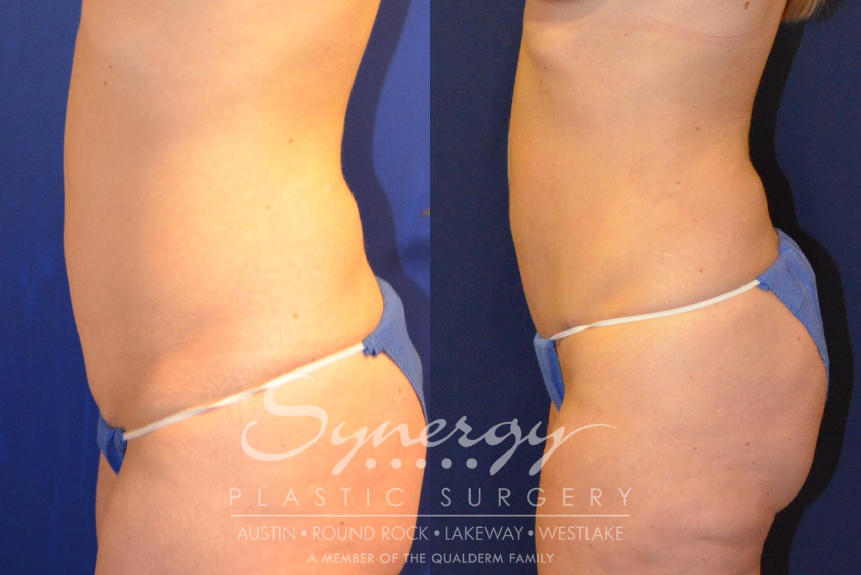 Before & After Abdominoplasty (Tummy Tuck) Case 223 View #3 View in Austin, TX