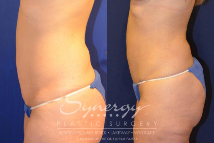 Before & After Abdominoplasty (Tummy Tuck) Case 223 View #3 View in Austin, TX
