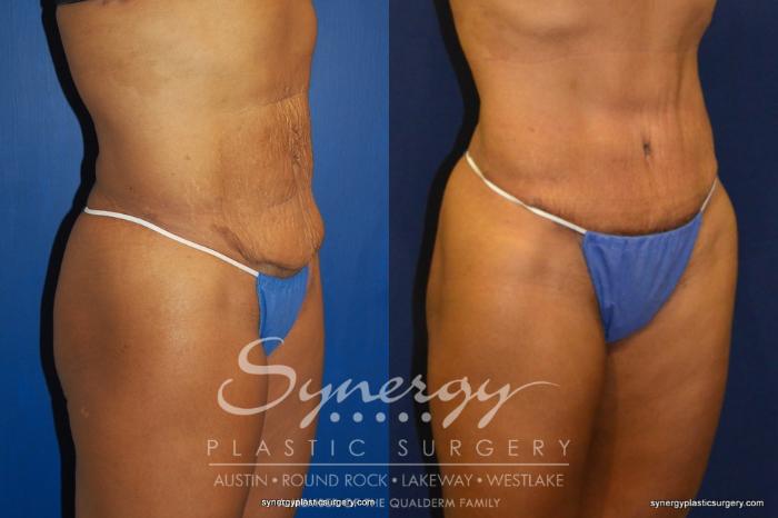 Before & After Abdominoplasty (Tummy Tuck) Case 229 View #3 View in Austin, TX