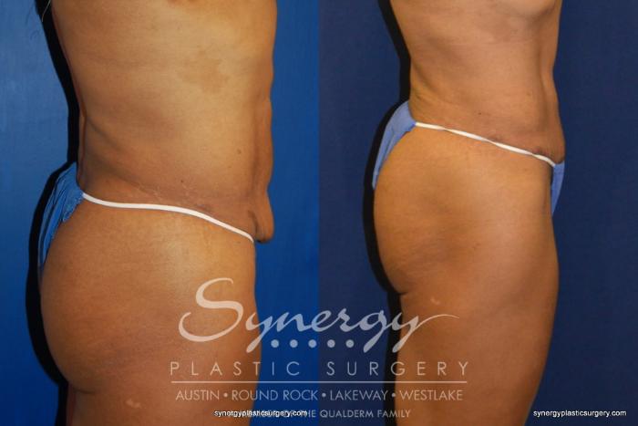 Before & After Abdominoplasty (Tummy Tuck) Case 229 View #4 View in Austin, TX