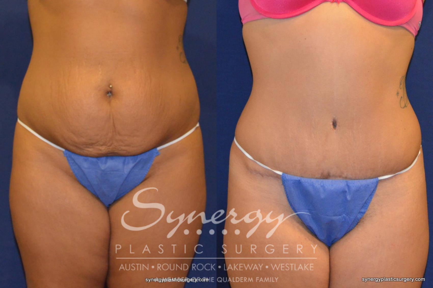 Before & After  Case 230 View #1 View in Austin, TX