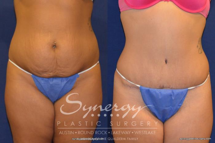 Before & After  Case 230 View #1 View in Austin, TX