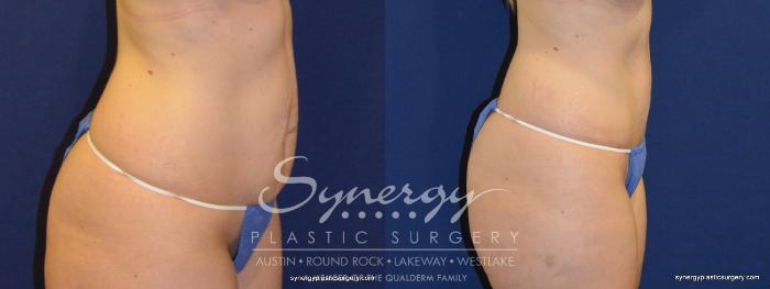 Before & After Abdominoplasty (Tummy Tuck) Case 232 View #2 View in Austin, TX