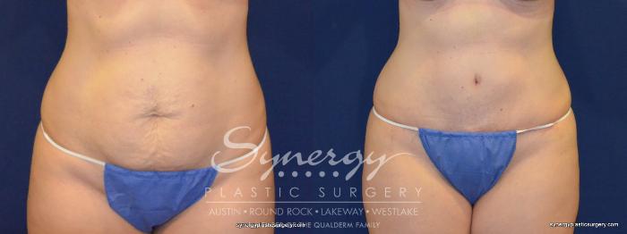 Before & After Abdominoplasty (Tummy Tuck) Case 232 View #3 View in Austin, TX