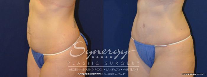 Before & After Abdominoplasty (Tummy Tuck) Case 232 View #4 View in Austin, TX