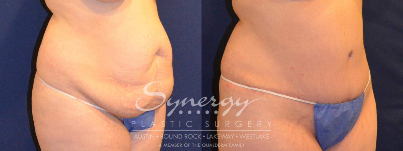 Before & After Abdominoplasty (Tummy Tuck) Case 292 View #2 View in Austin, TX