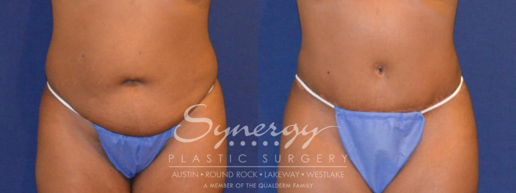 Before & After Abdominoplasty (Tummy Tuck) Case 299 View #1 View in Austin, TX