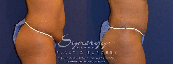 Before & After Abdominoplasty (Tummy Tuck) Case 299 View #2 View in Austin, TX