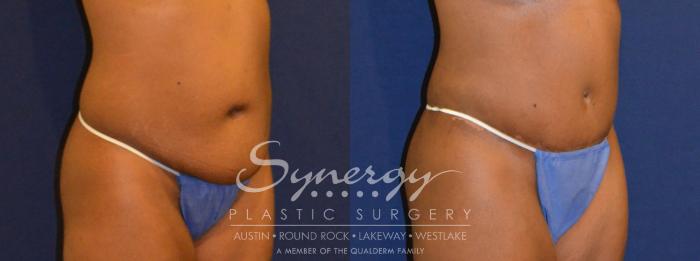 Before & After Abdominoplasty (Tummy Tuck) Case 299 View #3 View in Austin, TX