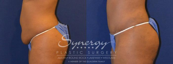 Before & After Abdominoplasty (Tummy Tuck) Case 299 View #4 View in Austin, TX