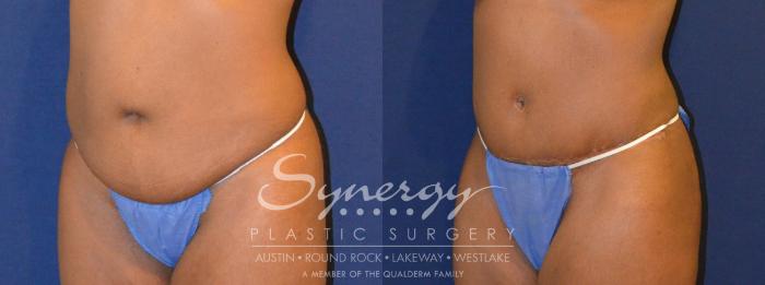 Before & After Abdominoplasty (Tummy Tuck) Case 299 View #5 View in Austin, TX