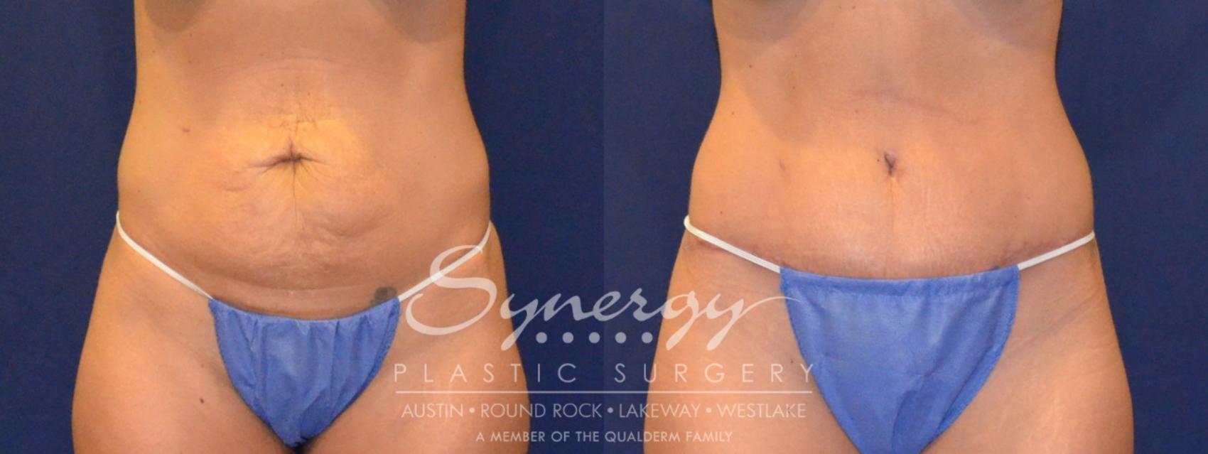 Before & After Abdominoplasty (Tummy Tuck) Case 302 View #1 View in Austin, TX