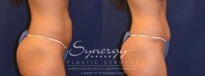 Before & After Abdominoplasty (Tummy Tuck) Case 302 View #2 View in Austin, TX