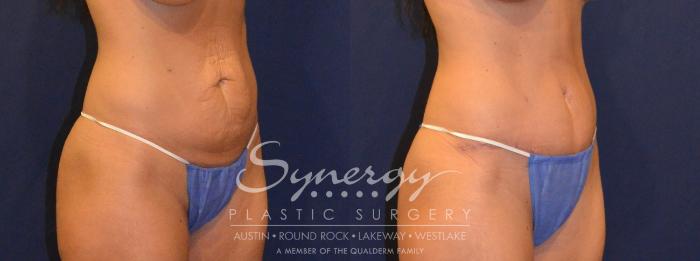 Before & After Abdominoplasty (Tummy Tuck) Case 302 View #3 View in Austin, TX