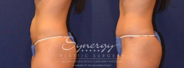 Before & After Abdominoplasty (Tummy Tuck) Case 302 View #4 View in Austin, TX