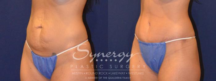Before & After Abdominoplasty (Tummy Tuck) Case 302 View #5 View in Austin, TX