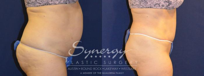 Before & After Abdominoplasty (Tummy Tuck) Case 306 View #2 View in Austin, TX