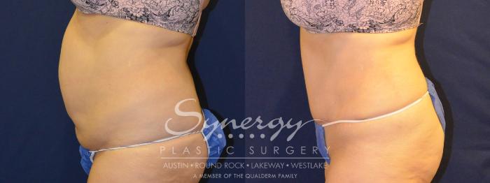 Before & After Abdominoplasty (Tummy Tuck) Case 306 View #4 View in Austin, TX
