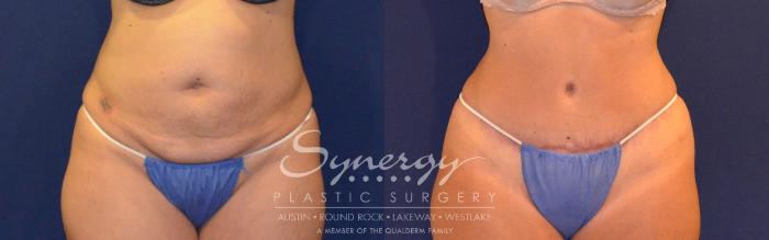 Before & After Abdominoplasty (Tummy Tuck) Case 308 View #1 View in Austin, TX