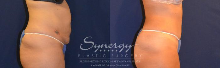 Before & After Abdominoplasty (Tummy Tuck) Case 308 View #2 View in Austin, TX