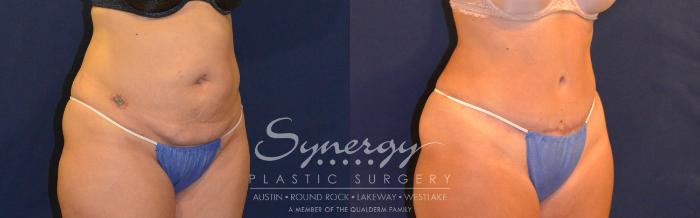 Before & After Abdominoplasty (Tummy Tuck) Case 308 View #3 View in Austin, TX