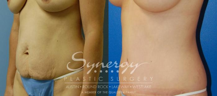 Before & After  Case 33 View #3 View in Austin, TX