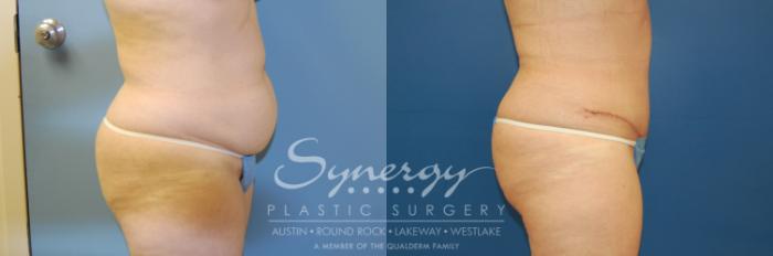 Before & After Abdominoplasty (Tummy Tuck) Case 4 View #4 View in Austin, TX
