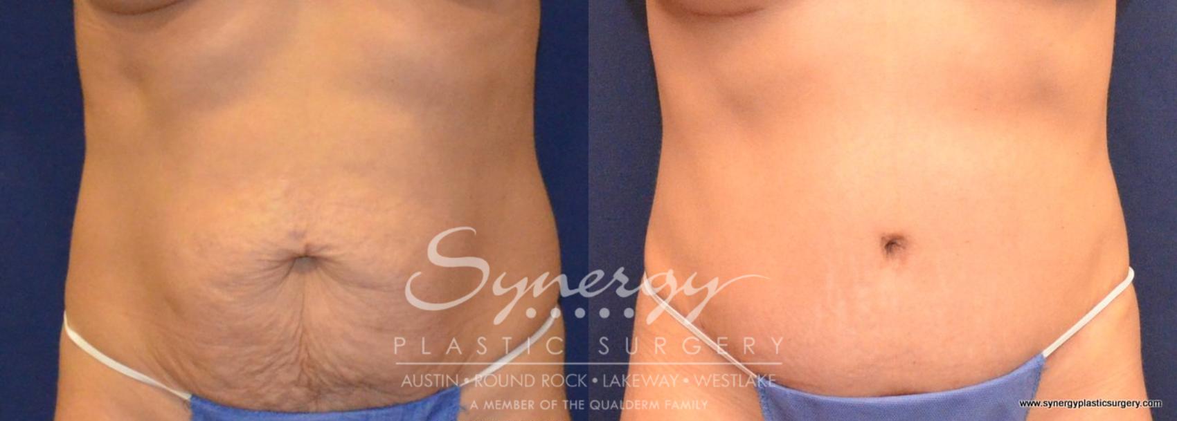 Before & After Abdominoplasty (Tummy Tuck) Case 429 View #1 View in Austin, TX