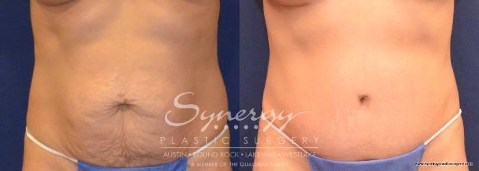 Before & After Abdominoplasty (Tummy Tuck) Case 429 View #1 View in Austin, TX