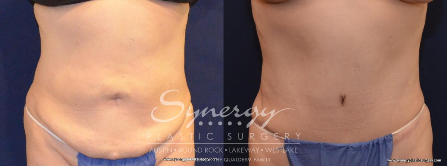 Before & After Abdominoplasty (Tummy Tuck) Case 445 View #1 View in Austin, TX
