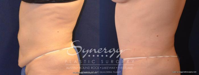 Before & After Abdominoplasty (Tummy Tuck) Case 445 View #4 View in Austin, TX