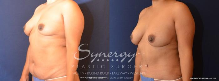 Before & After Abdominoplasty (Tummy Tuck) Case 446 View #2 View in Austin, TX