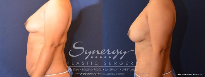 Before & After Abdominoplasty (Tummy Tuck) Case 446 View #3 View in Austin, TX