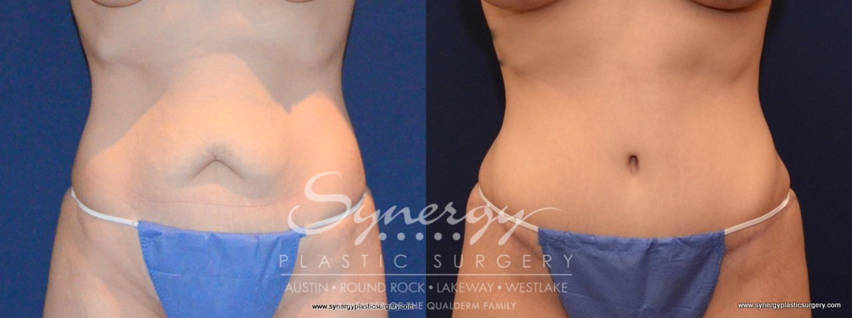 Before & After Abdominoplasty (Tummy Tuck) Case 455 View #1 View in Austin, TX