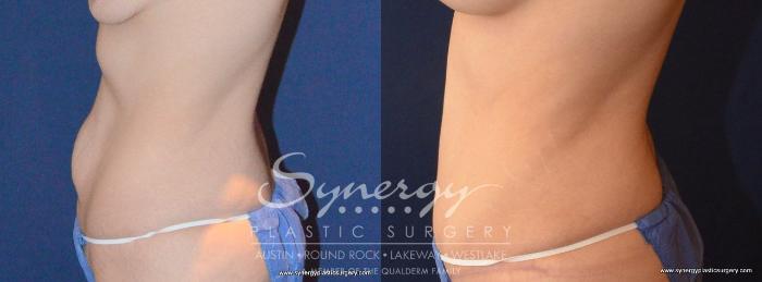 Before & After Abdominoplasty (Tummy Tuck) Case 455 View #2 View in Austin, TX