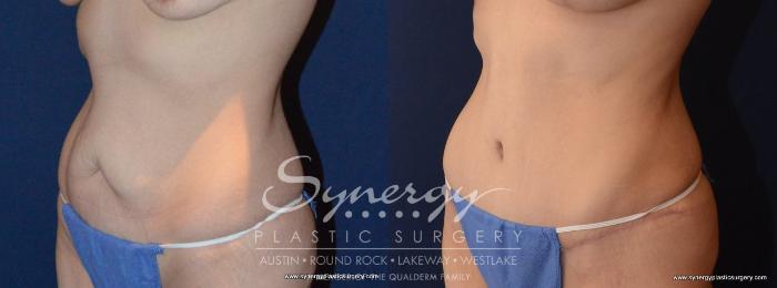 Before & After Abdominoplasty (Tummy Tuck) Case 455 View #3 View in Austin, TX