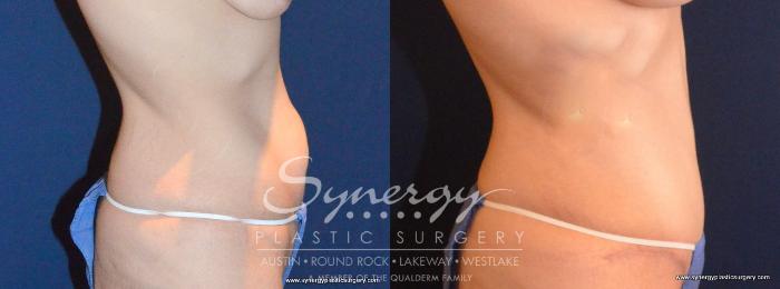 Before & After Abdominoplasty (Tummy Tuck) Case 455 View #4 View in Austin, TX