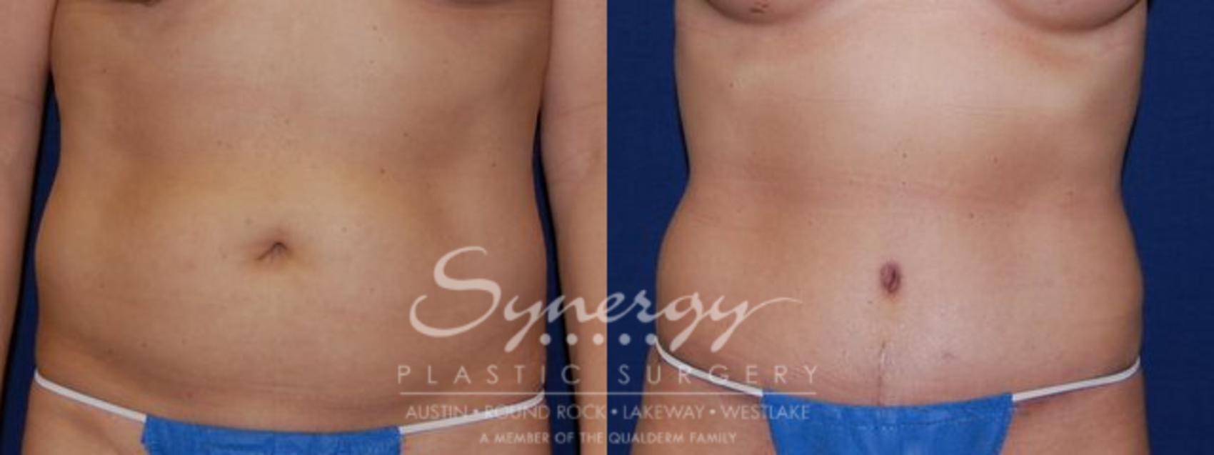 Before & After Abdominoplasty (Tummy Tuck) Case 50 View #1 View in Austin, TX
