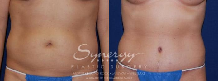 Before & After Abdominoplasty (Tummy Tuck) Case 50 View #1 View in Austin, TX