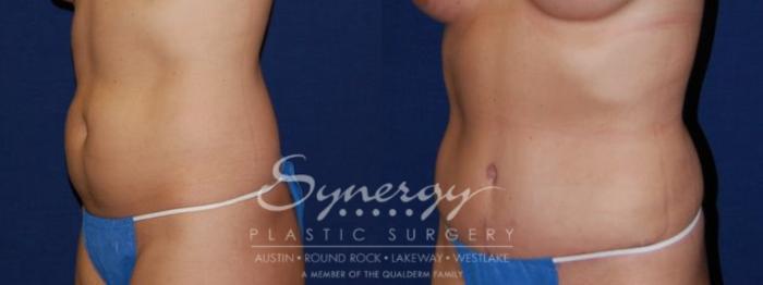 Before & After Abdominoplasty (Tummy Tuck) Case 50 View #2 View in Austin, TX