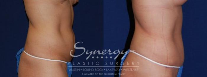 Before & After Abdominoplasty (Tummy Tuck) Case 50 View #4 View in Austin, TX