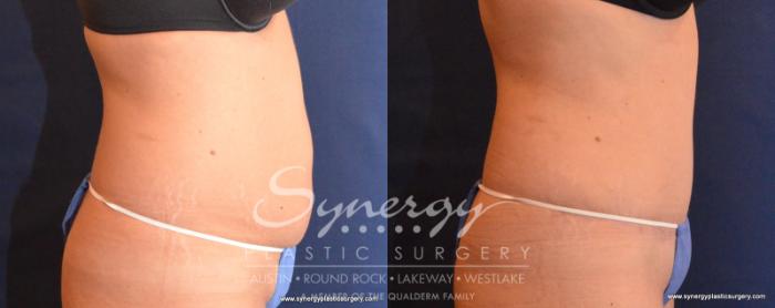 Before & After Abdominoplasty (Tummy Tuck) Case 543 View #3 View in Austin, TX