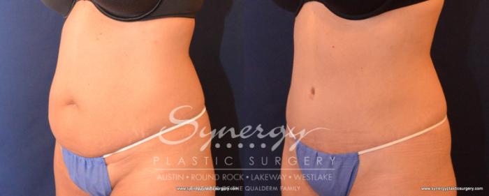 Before & After Abdominoplasty (Tummy Tuck) Case 543 View #5 View in Austin, TX